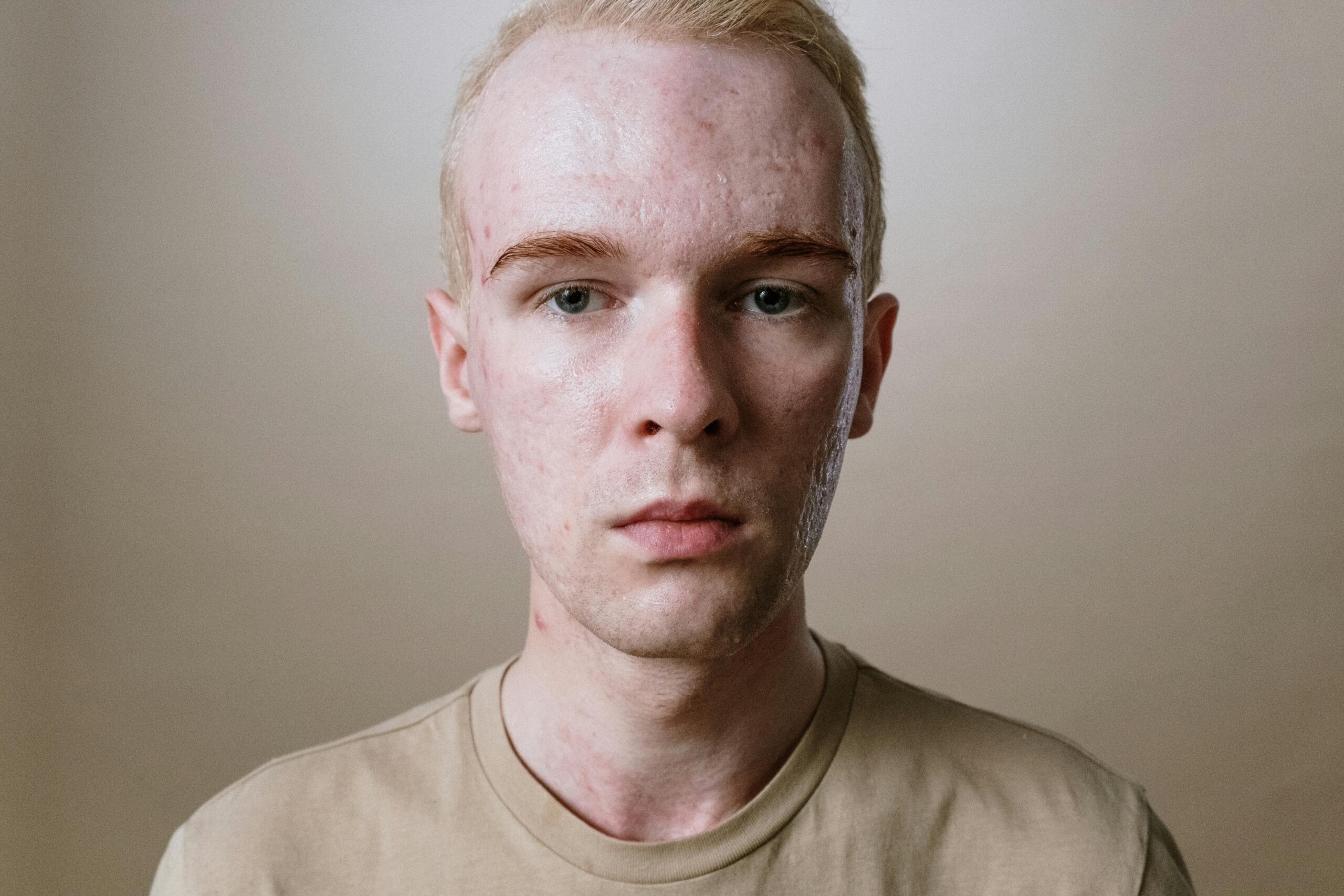 A close-up portrait of a blonde man with acne portraying a candid expression and natural look.