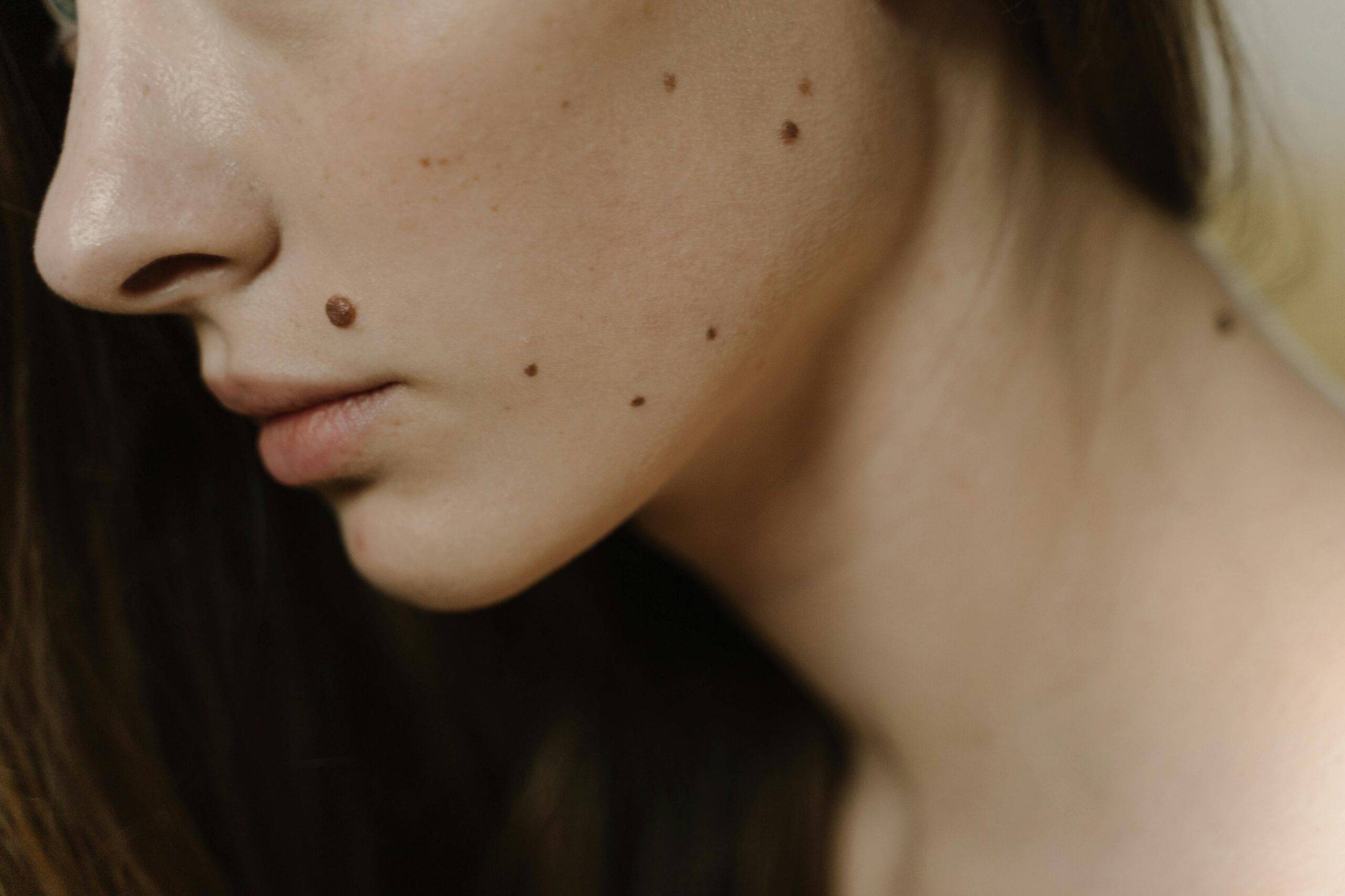 Detailed close-up of a woman's face, focusing on skin with multiple moles.