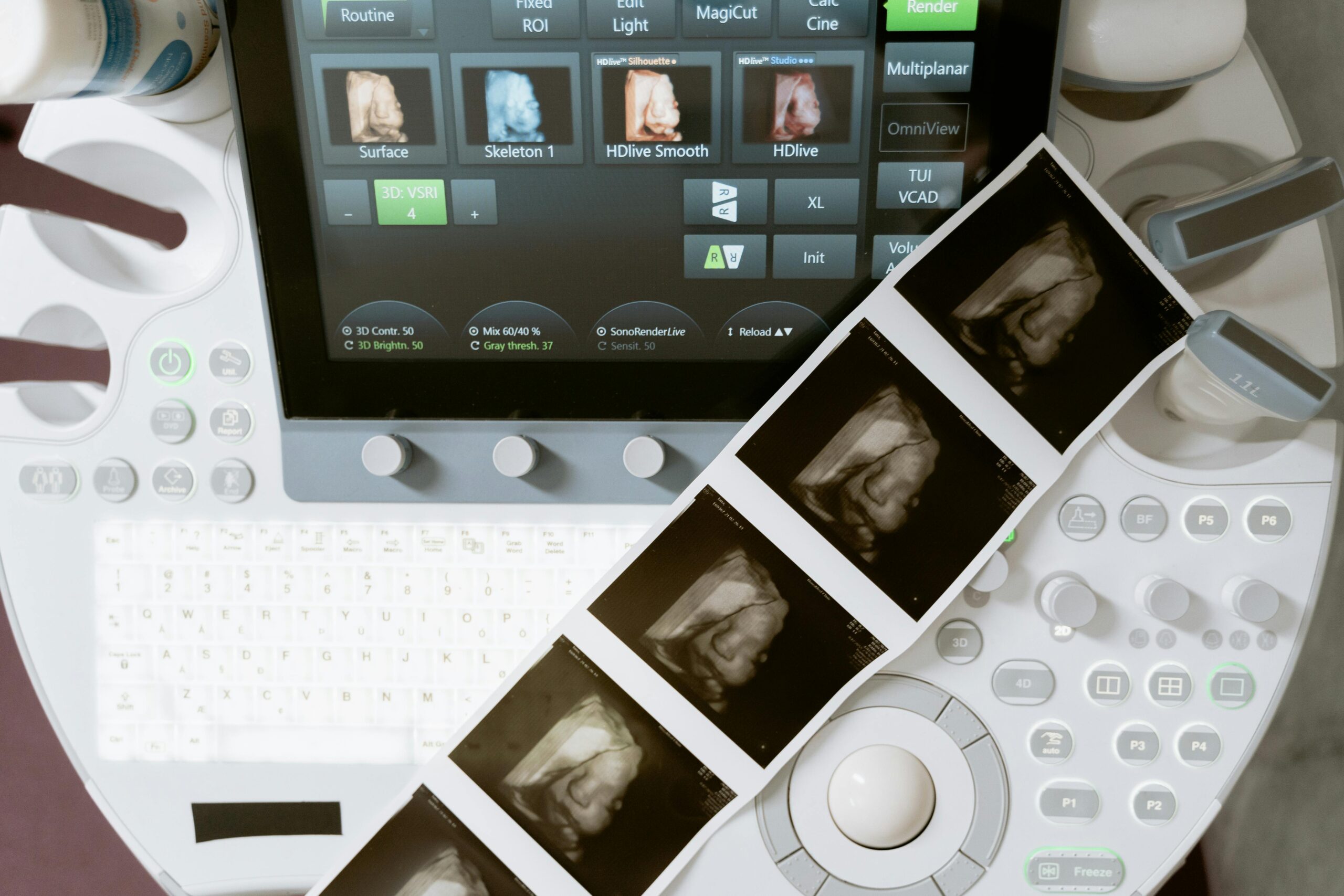 Ultrasound machine displaying 3D scans, with printed sonogram images adjoining.