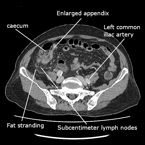 Acute Appendicitis Sonography