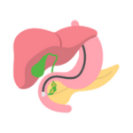 Gallstones