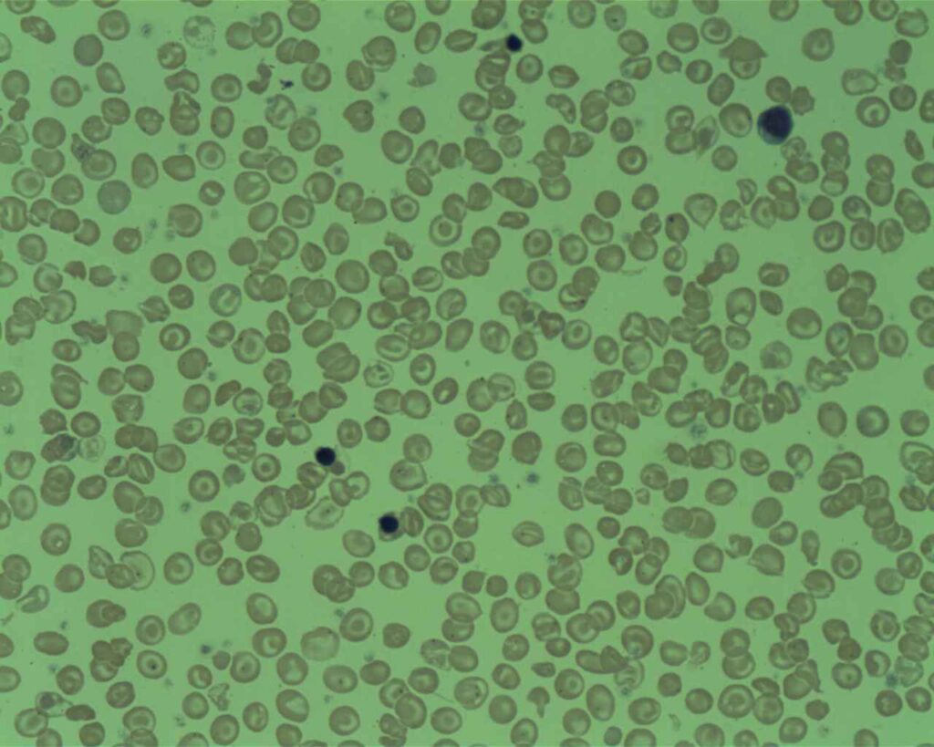 Hypothyroidism in Thalassemia